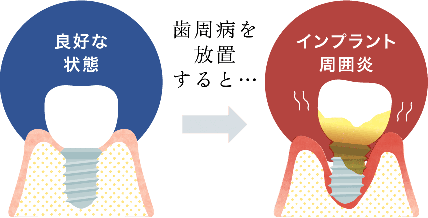 歯周病を放置すると、インプラント周囲炎に