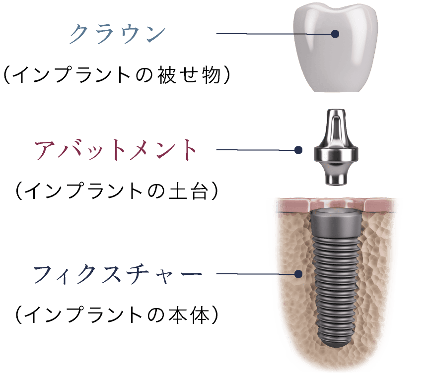 クラウン(インプラントの被せ物)、アバットメント(インプラントの土台)、フィクスチャー(インプラントの本体)
