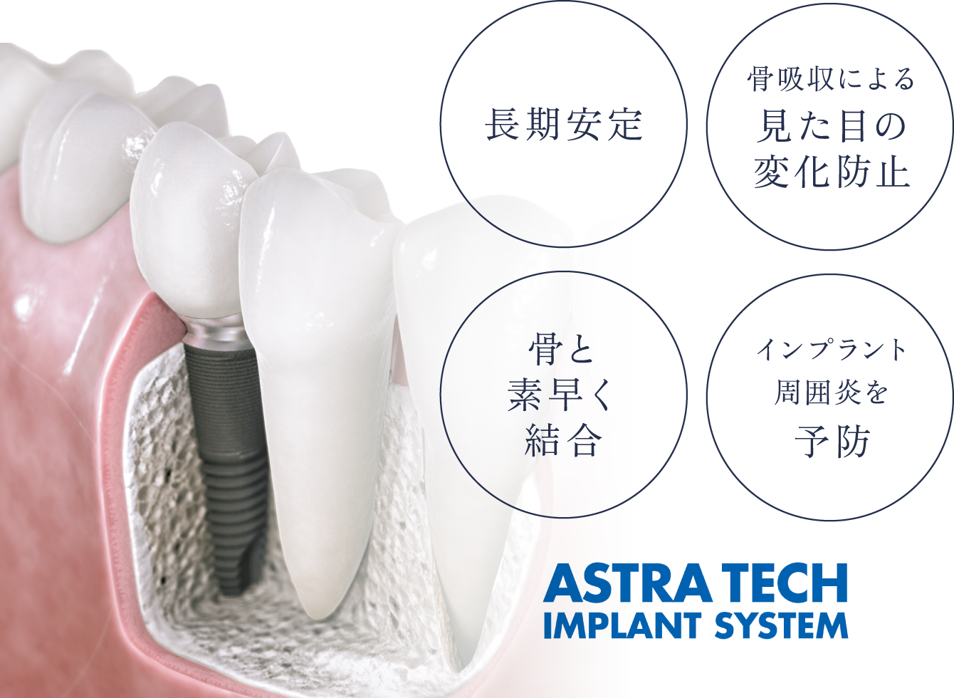 長期安定・骨吸収による見た目の変化防止・骨と素早く結合・インプラント周囲炎を予防