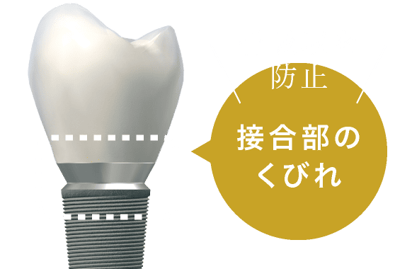接合部のくびれが、骨吸収を防止